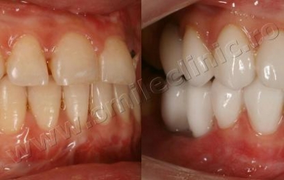 Integral ceramic veneers