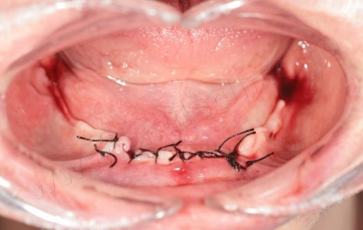 Supraprotezare pe implanturi mandibula
