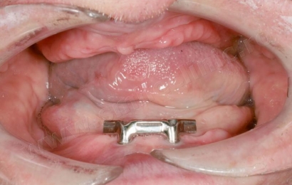 Supraprotezare pe implanturi mandibula