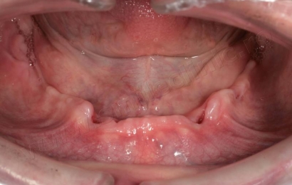 Supraprotezare pe implanturi mandibula