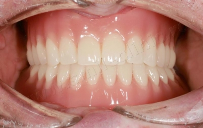 Supraprotezare pe implanturi mandibula