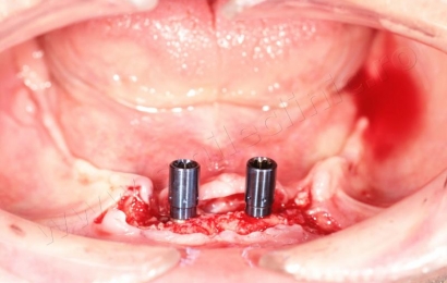 Supraprotezare pe implanturi mandibula